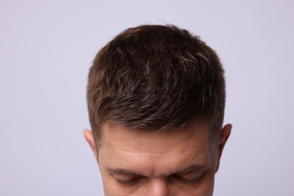 Biohacking Your Hairline: Practical Tips for Using Peptide Droppers to Combat Recession